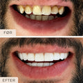 Composite Veneers